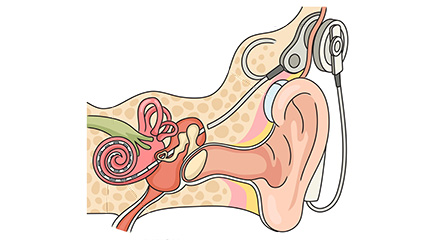 The inner ear has implanted electrodes, and on the exterior, the patient wears a sound processor.