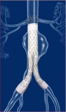 Graphic representation of a stent-graft (a mesh tube covered in fabric), used to reinforce the weakened part of an aorta